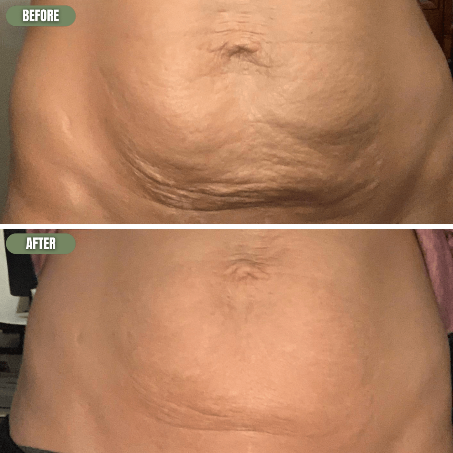 Suvéea Anti Cellulite Massage Oil